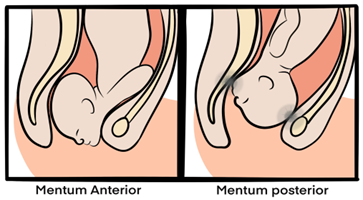 face presentation mentum posterior